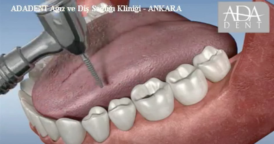 Endodonti Kanal Tedavisi